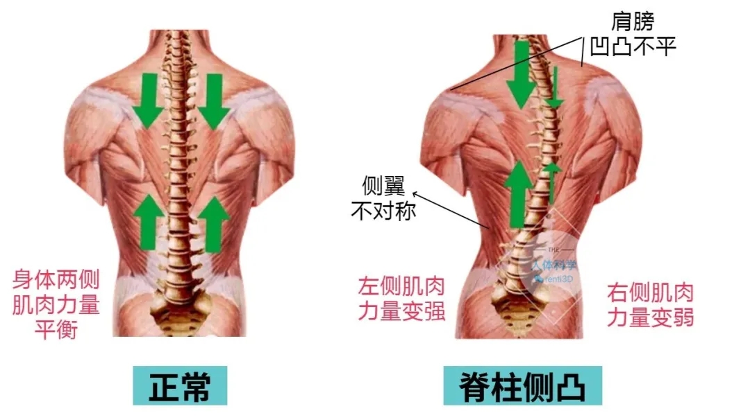 3D打印脊柱側彎矯形器：從“被動矯正”到“精準醫療”的跨越式革新  